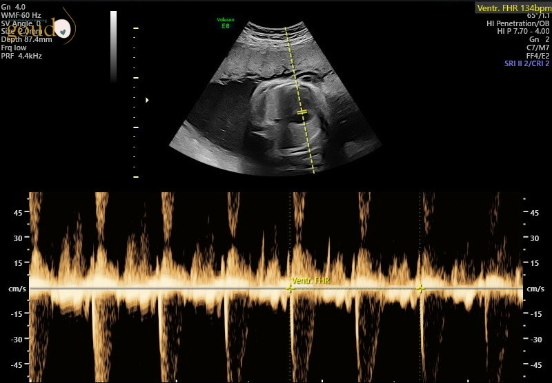 13 weken echo bij Goud echo en prenatale screening in Kampen, Ermelo, Almere en Lelystad
