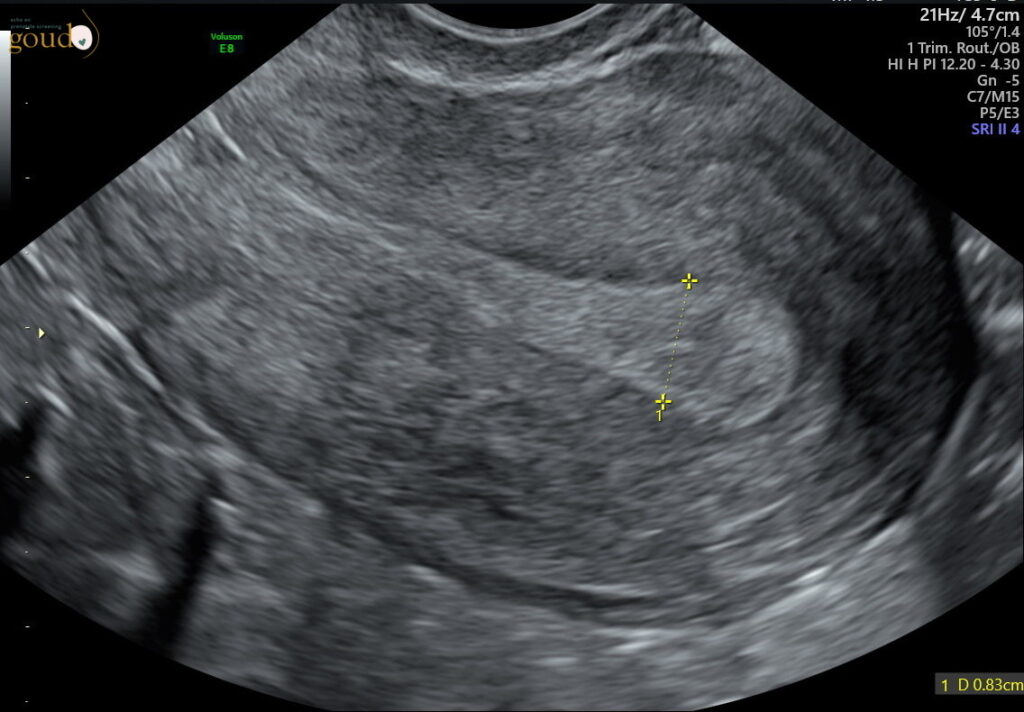 Echo follikel meting fertiliteitstraject