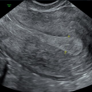 Echo follikel meting fertiliteitstraject