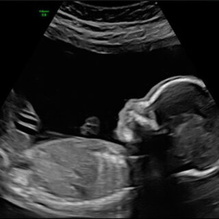 20 weken echo bij goud echo en prenatale screening in Kampen, Ermelo, Almere en Lelystad