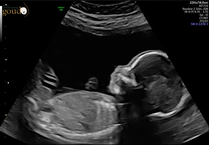 20 weken echo bij goud echo en prenatale screening in Kampen, Ermelo, Almere en Lelystad