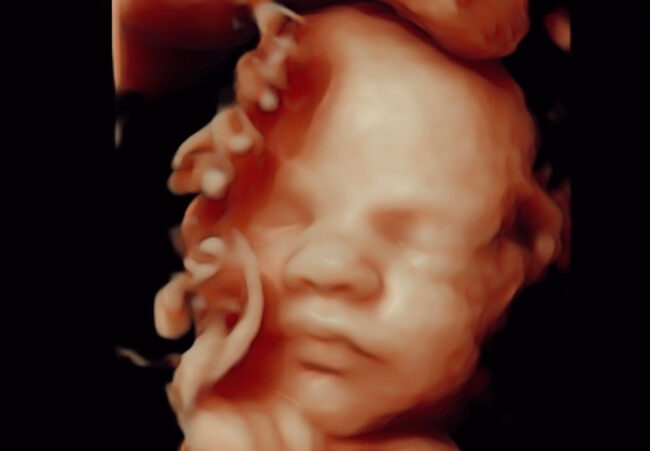 3D 4D pretecho gemaakt bij Goud echo en prenatale screening